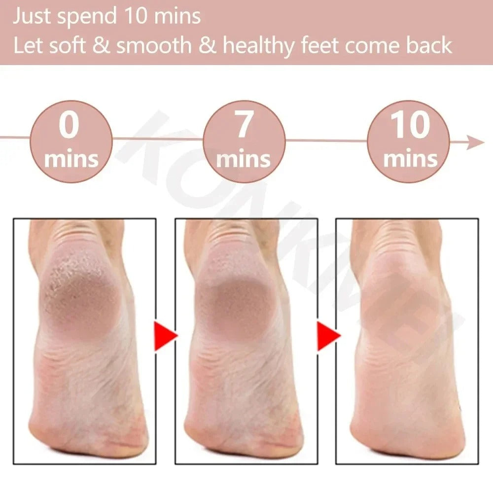 Electric Foot Callus Remover & Grinder – Rechargeable Foot File with Vacuum for Cracked Heels & Dead Skin